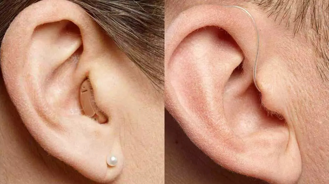 Görünmeyen İşitme Cihazı Nedir, Kimler İçin Uygundur?